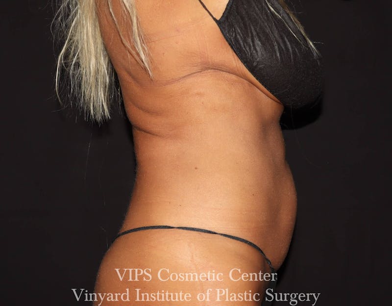 Coolsculpting ELITE Before & After Gallery - Patient 171436679 - Image 6