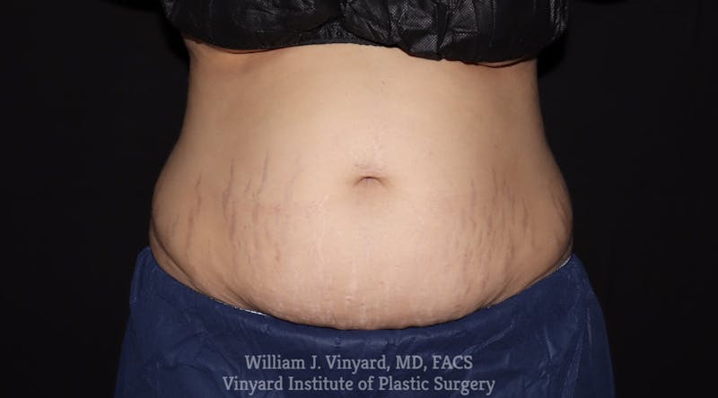 Coolsculpting ELITE Before & After Gallery - Patient 171436680 - Image 1
