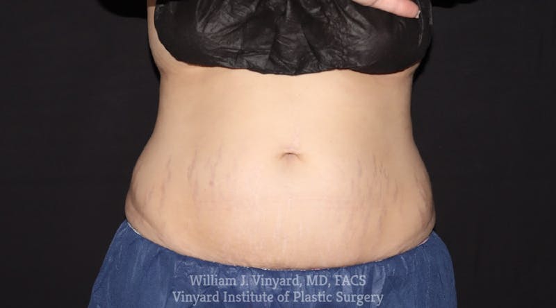 Coolsculpting ELITE Before & After Gallery - Patient 171436680 - Image 2