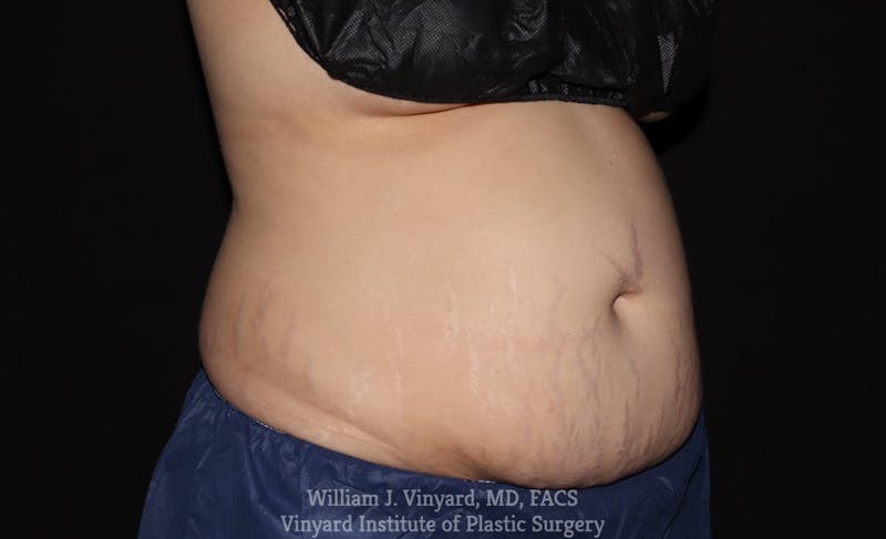 Coolsculpting ELITE Before & After Gallery - Patient 171436680 - Image 3