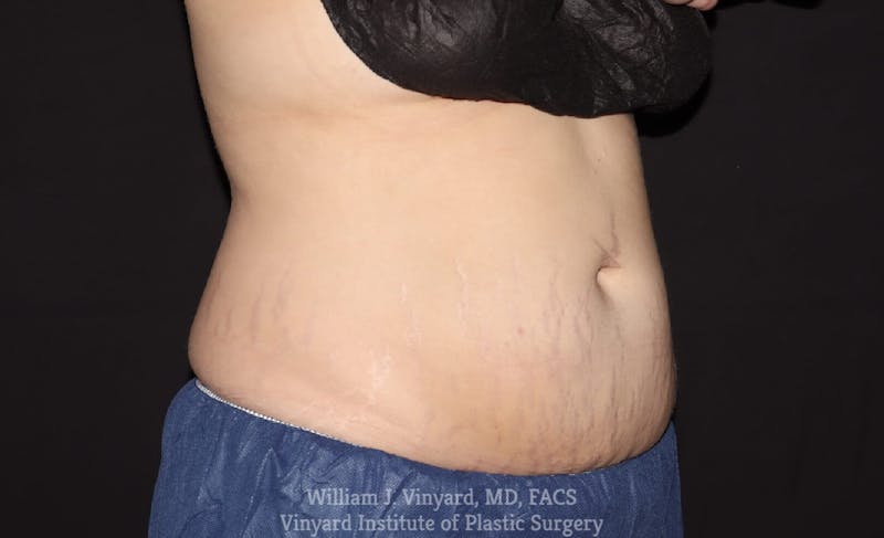 Coolsculpting ELITE Before & After Gallery - Patient 171436680 - Image 4