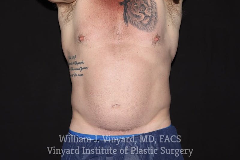 Coolsculpting ELITE Before & After Gallery - Patient 171436729 - Image 1