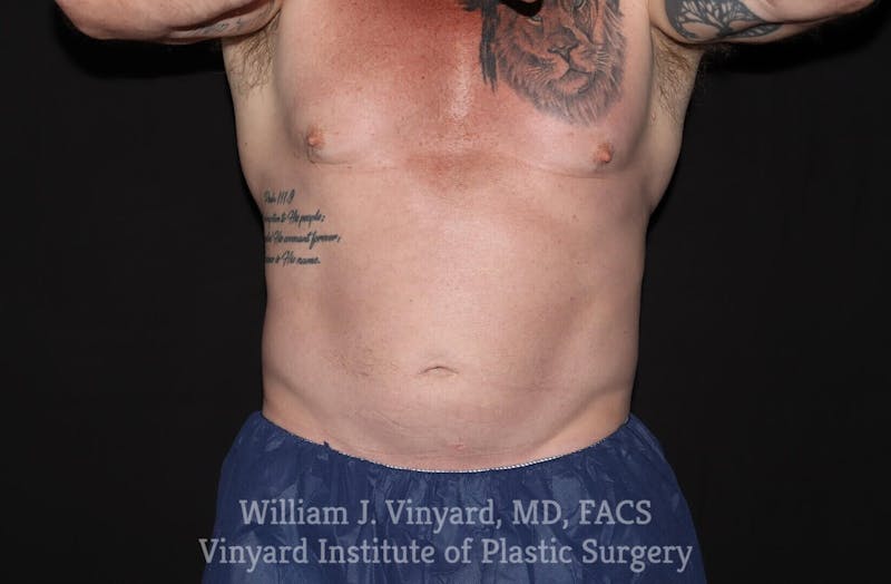 Coolsculpting ELITE Before & After Gallery - Patient 171436729 - Image 2