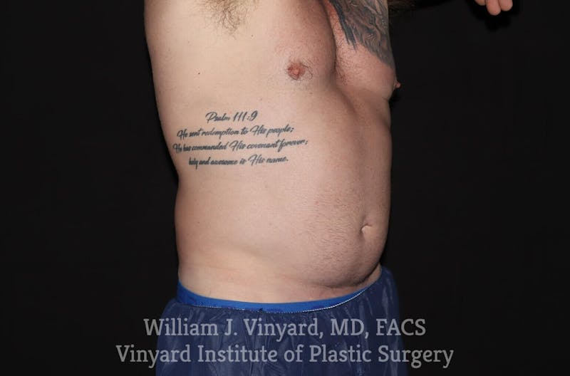 Coolsculpting ELITE Before & After Gallery - Patient 171436729 - Image 3