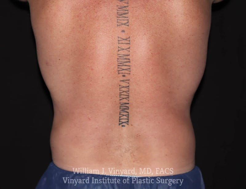 Coolsculpting ELITE Before & After Gallery - Patient 171436729 - Image 5