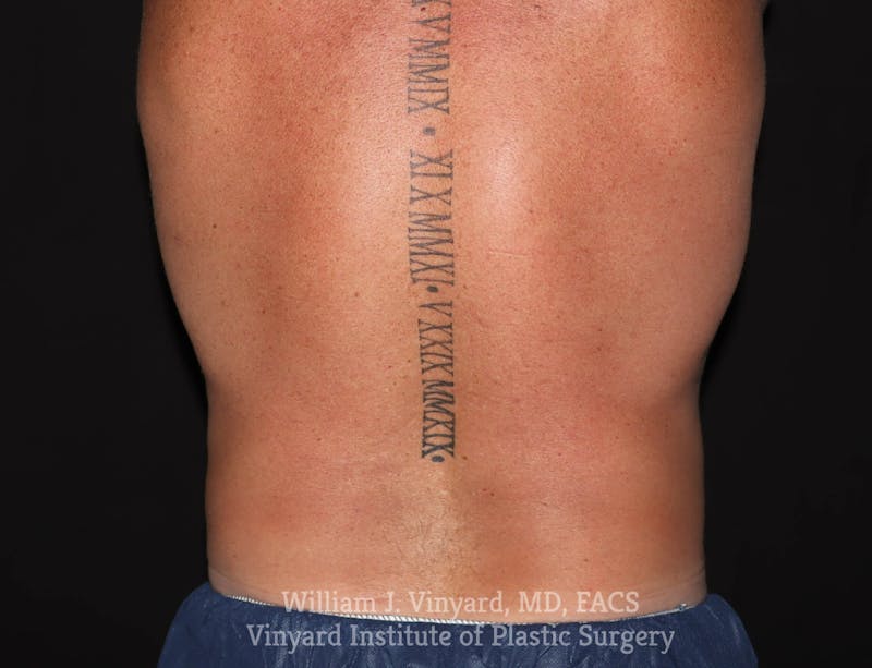 Coolsculpting ELITE Before & After Gallery - Patient 171436729 - Image 6