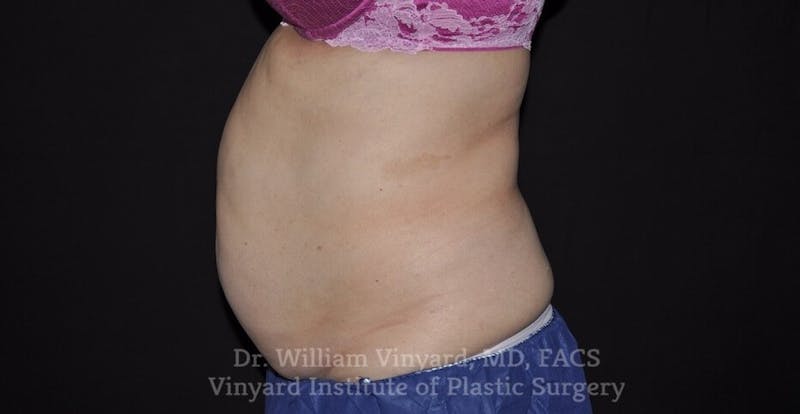 Coolsculpting ELITE Before & After Gallery - Patient 171436952 - Image 1