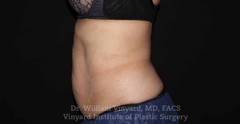 Coolsculpting ELITE Before & After Gallery - Patient 171436952 - Image 2