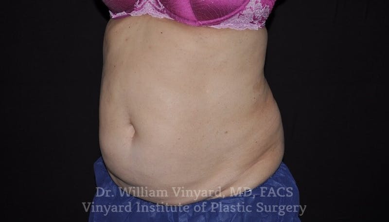 Coolsculpting ELITE Before & After Gallery - Patient 171436952 - Image 3