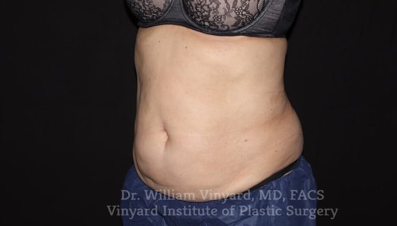 Coolsculpting ELITE Before & After Gallery - Patient 171436952 - Image 4