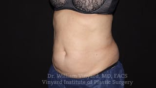 Coolsculpting ELITE Before & After Gallery - Patient 171436952 - Image 4
