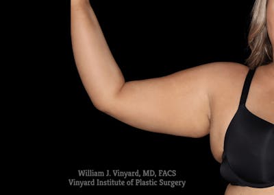 Coolsculpting ELITE Before & After Gallery - Patient 171437040 - Image 2