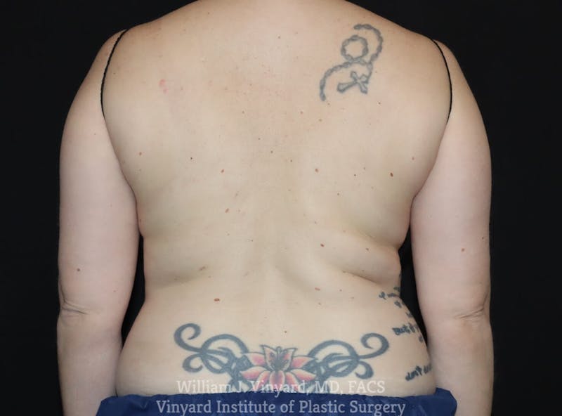 Coolsculpting ELITE Before & After Gallery - Patient 171437164 - Image 1