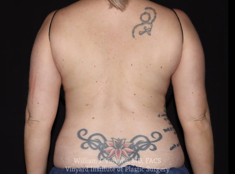 Coolsculpting ELITE Before & After Gallery - Patient 171437164 - Image 2