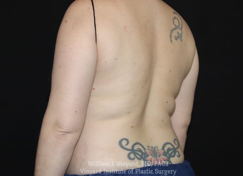 Coolsculpting ELITE Before & After Gallery - Patient 171437164 - Image 3