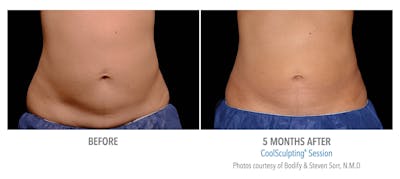 Coolsculpting ELITE Before & After Gallery - Patient 171437167 - Image 1