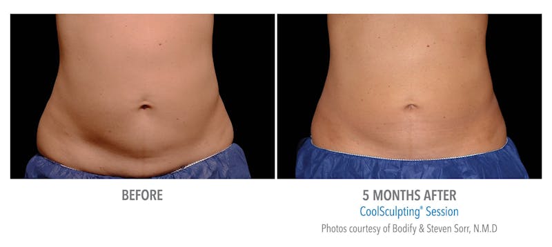 Coolsculpting ELITE Before & After Gallery - Patient 171437167 - Image 1