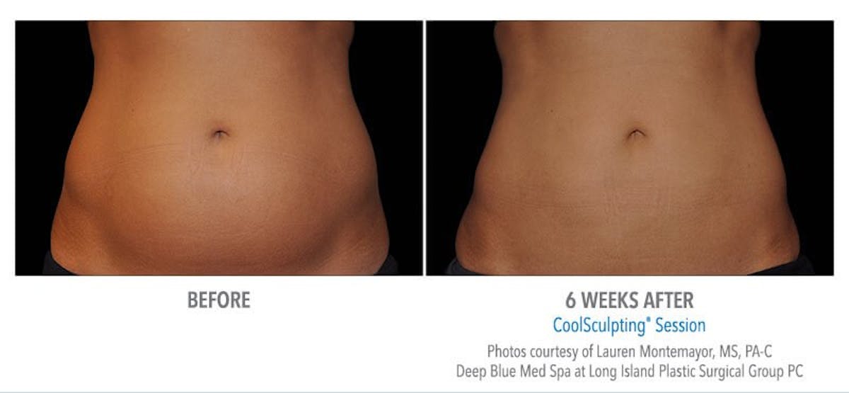 Coolsculpting ELITE Before & After Gallery - Patient 171437168 - Image 1