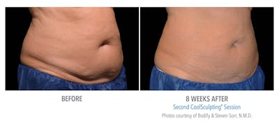 Coolsculpting ELITE Before & After Gallery - Patient 171437170 - Image 1
