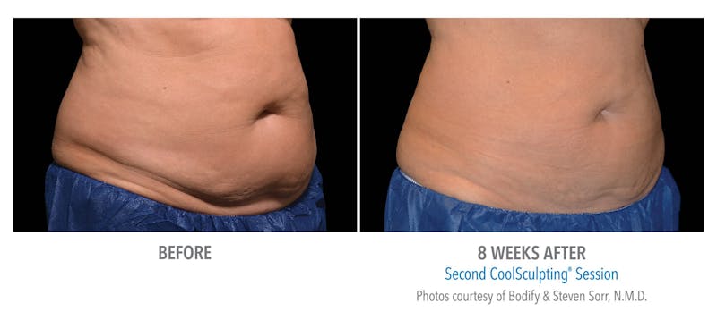 Coolsculpting ELITE Before & After Gallery - Patient 171437170 - Image 1