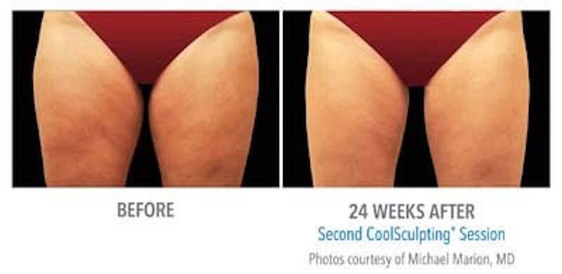 Coolsculpting ELITE Before & After Gallery - Patient 171437173 - Image 1