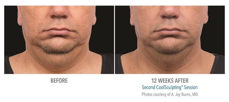 Coolsculpting ELITE Before & After Gallery - Patient 171437181 - Image 1