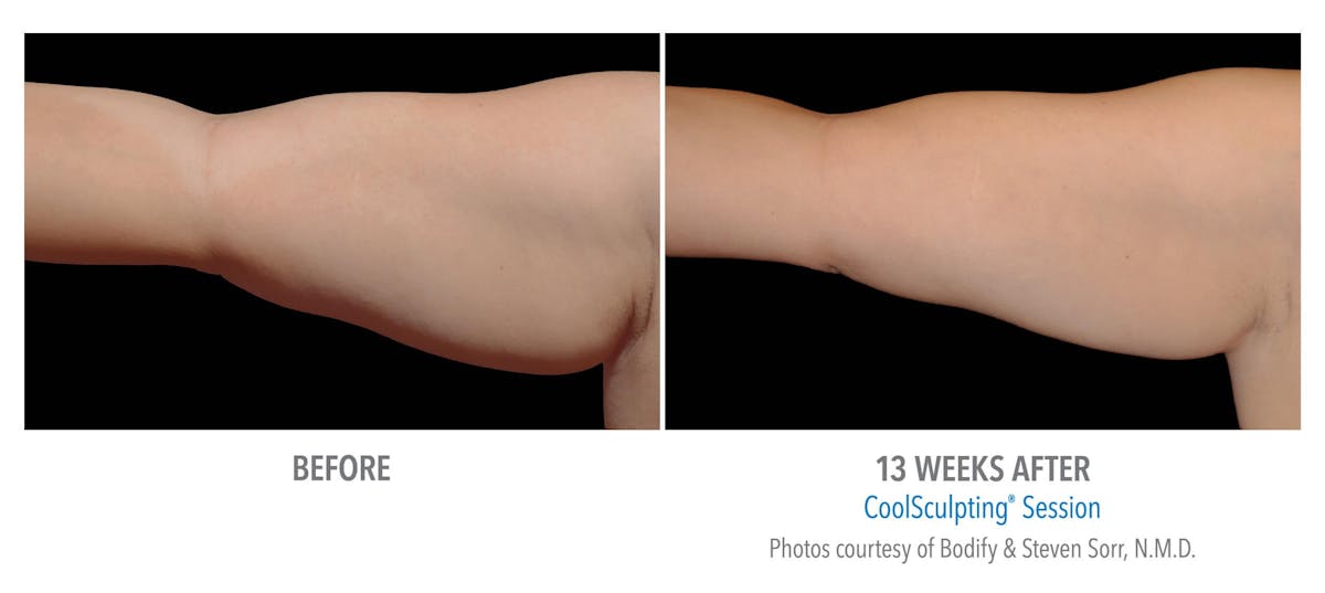 Coolsculpting ELITE Before & After Gallery - Patient 171437182 - Image 1