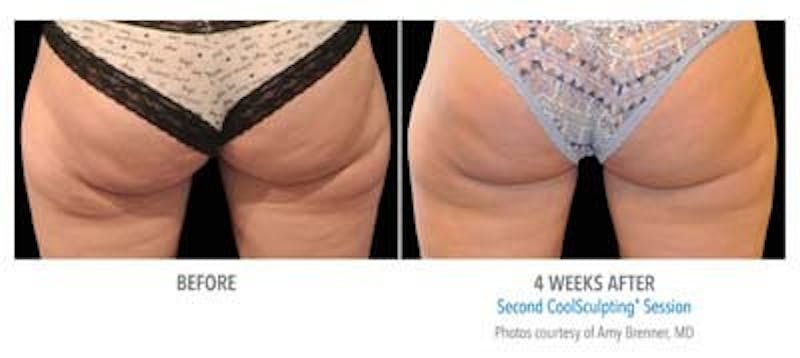 Coolsculpting ELITE Before & After Gallery - Patient 171437188 - Image 1