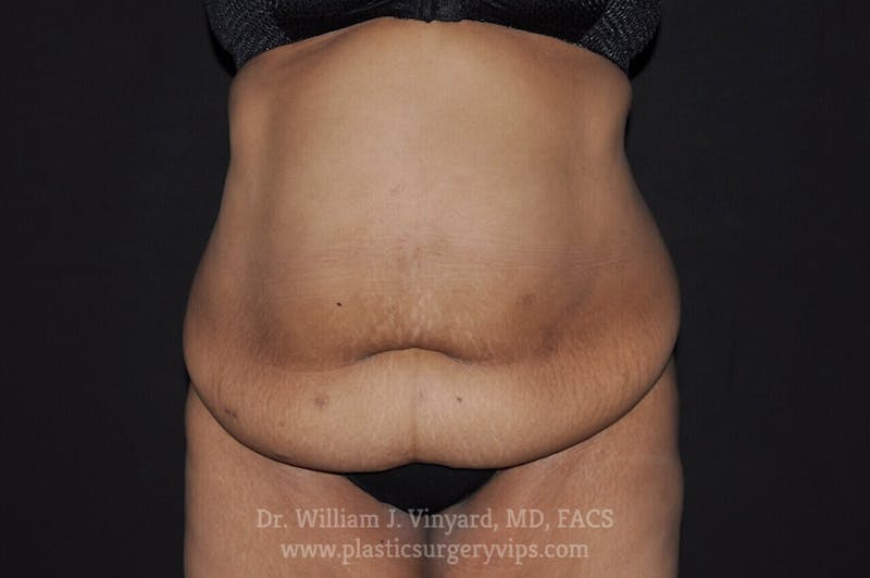 Tummy Tuck Before & After Gallery - Patient 171441362 - Image 1