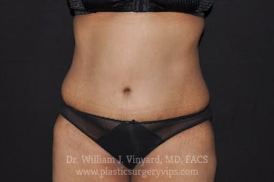 Tummy Tuck Before & After Gallery - Patient 171441362 - Image 2
