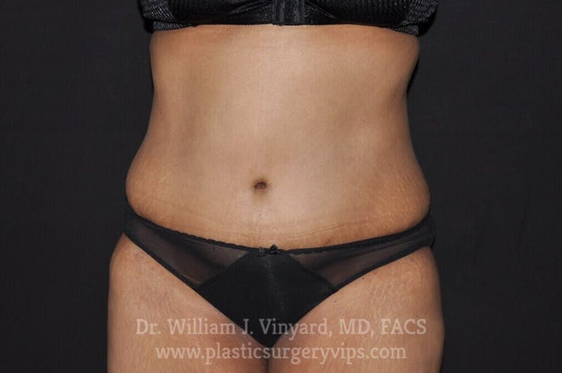 Tummy Tuck Before & After Gallery - Patient 171441362 - Image 2