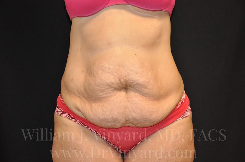 Tummy Tuck Before & After Gallery - Patient 171441489 - Image 1