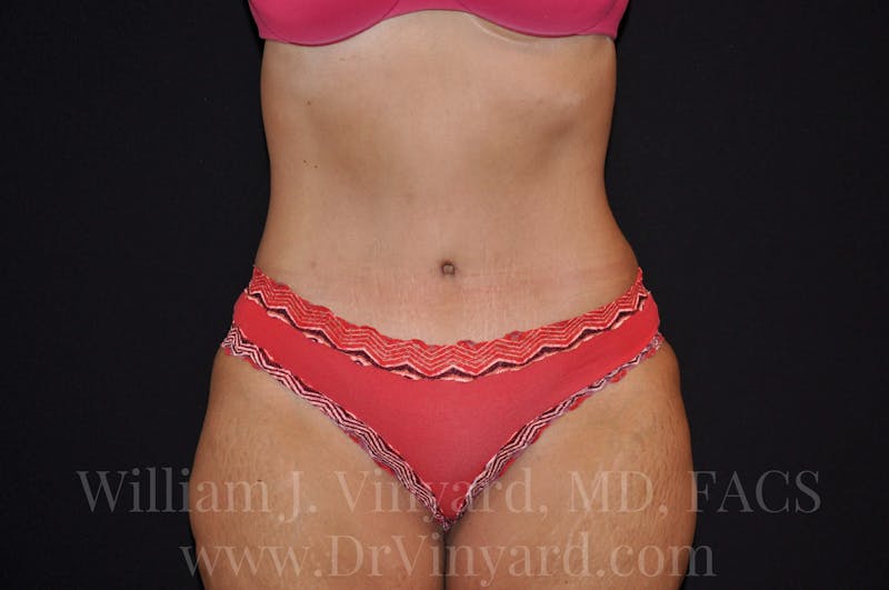 Tummy Tuck Before & After Gallery - Patient 171441489 - Image 2