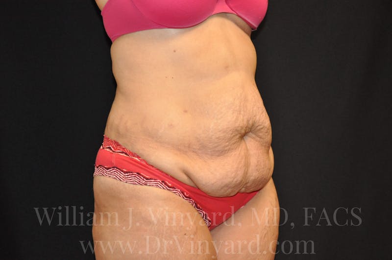 Tummy Tuck Before & After Gallery - Patient 171441489 - Image 3