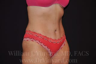 Tummy Tuck Before & After Gallery - Patient 171441489 - Image 4