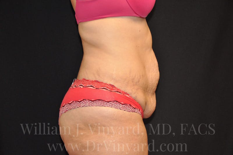 Tummy Tuck Before & After Gallery - Patient 171441489 - Image 5
