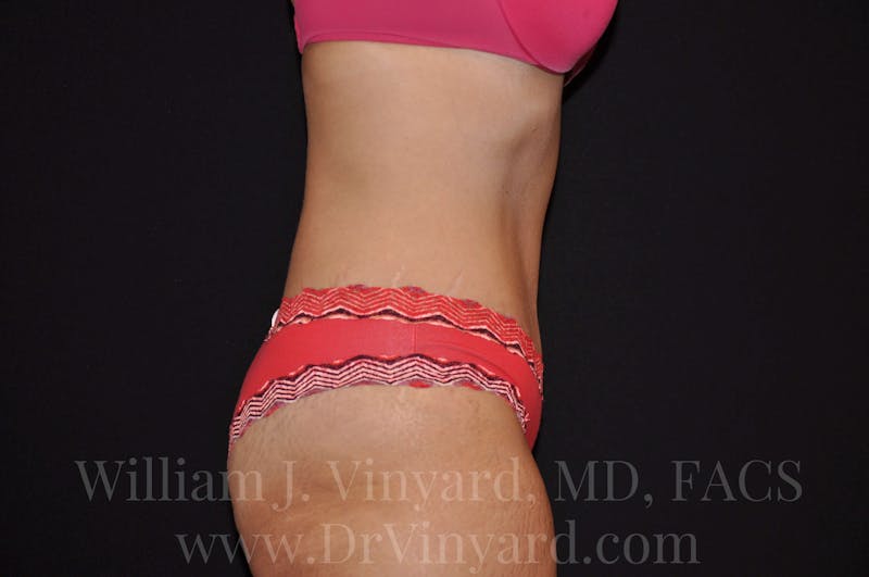 Tummy Tuck Before & After Gallery - Patient 171441489 - Image 6