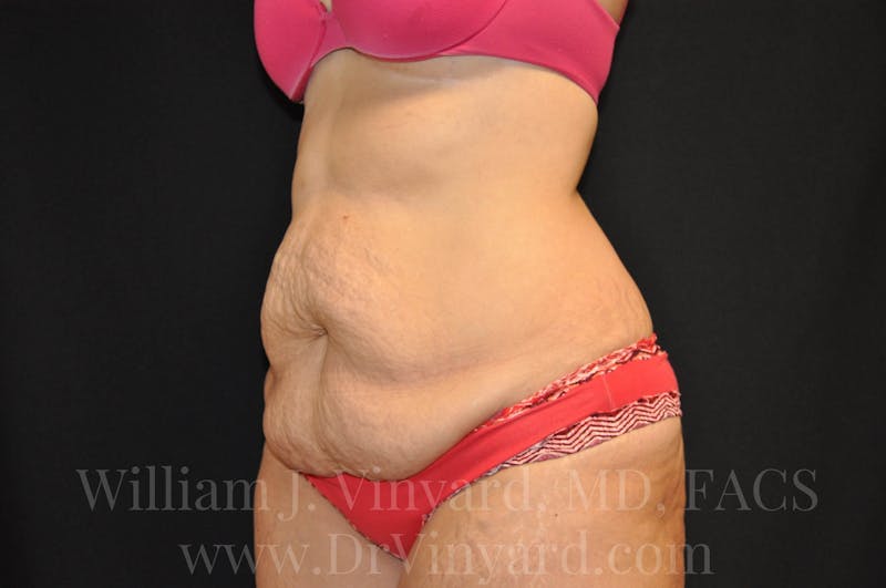 Tummy Tuck Before & After Gallery - Patient 171441489 - Image 7
