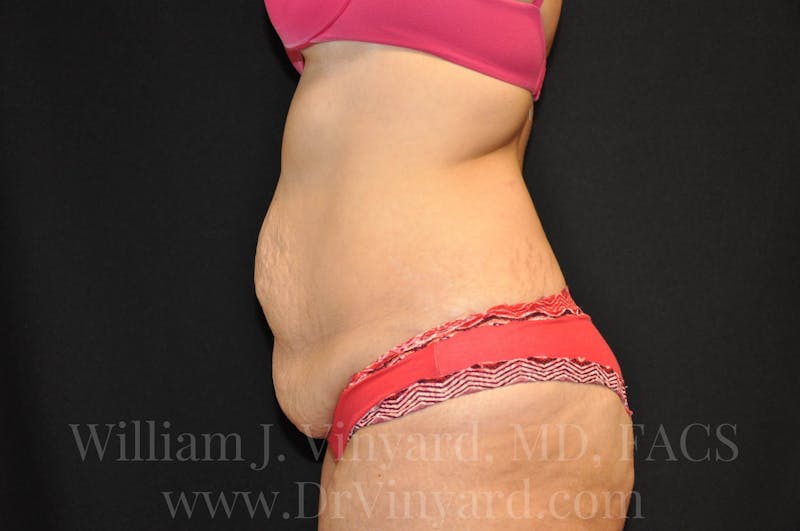 Tummy Tuck Before & After Gallery - Patient 171441489 - Image 9