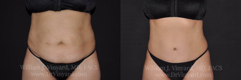 Tummy Tuck Before & After Gallery - Patient 171441508 - Image 1
