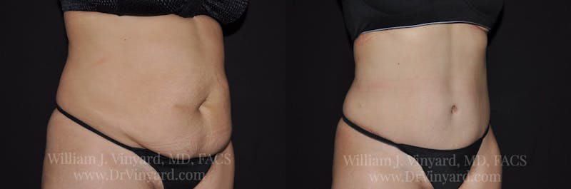 Tummy Tuck Before & After Gallery - Patient 171441508 - Image 3