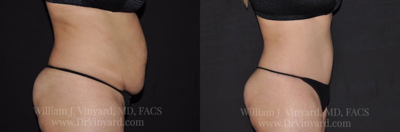 Tummy Tuck Before & After Gallery - Patient 171441508 - Image 5