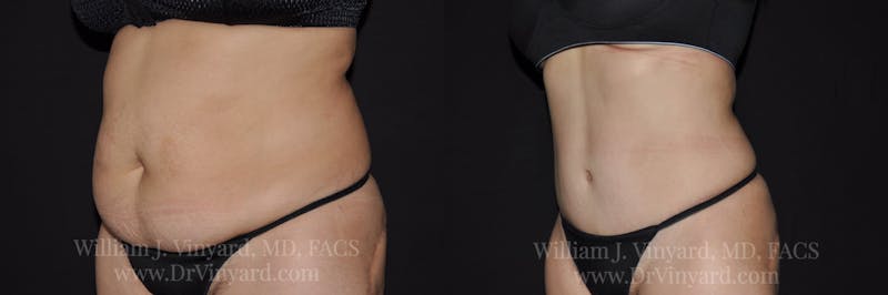 Tummy Tuck Before & After Gallery - Patient 171441508 - Image 7