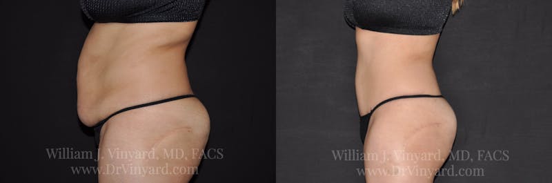 Tummy Tuck Before & After Gallery - Patient 171441508 - Image 9