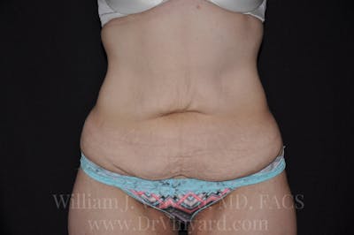 Tummy Tuck Before & After Gallery - Patient 171441518 - Image 1