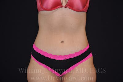 Tummy Tuck Before & After Gallery - Patient 171441518 - Image 2