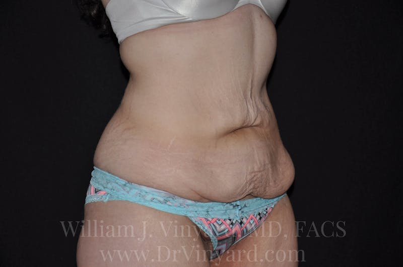 Tummy Tuck Before & After Gallery - Patient 171441518 - Image 3