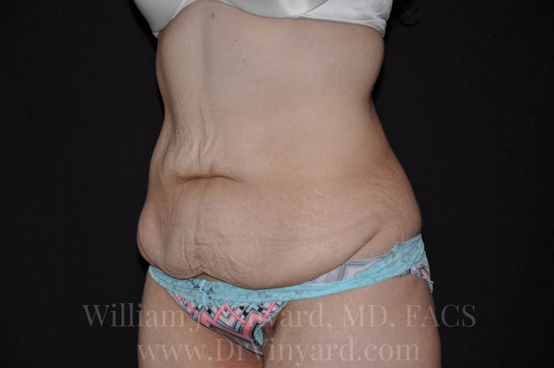 Tummy Tuck Before & After Gallery - Patient 171441518 - Image 7
