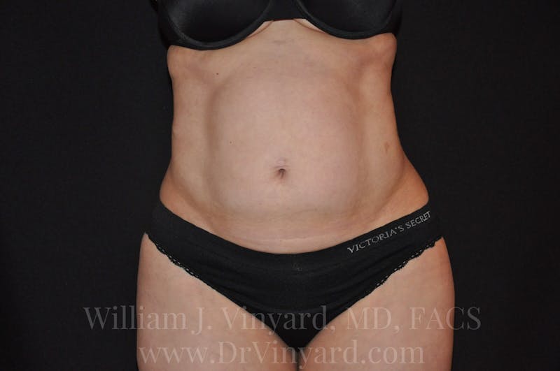 Tummy Tuck Before & After Gallery - Patient 171441910 - Image 1