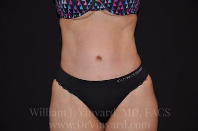 Tummy Tuck Before & After Gallery - Patient 171441910 - Image 2